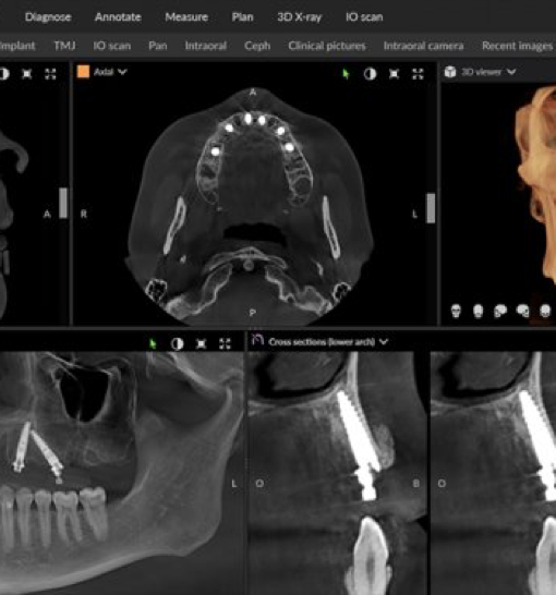 3D-Planung bei Implantaten